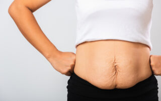 A woman with her white shirt pulled up to show loose belly skin to help illustrate How to Avoid Loose Skin After Weight Loss Surgery