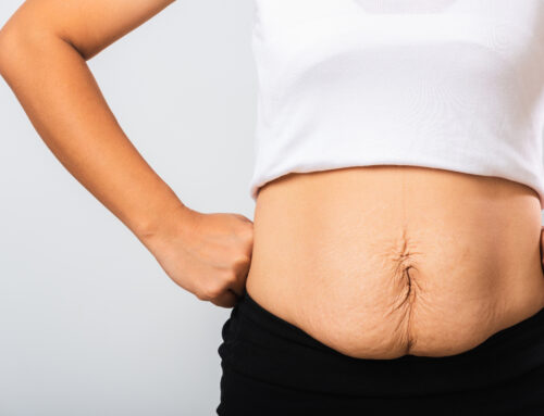 How to Avoid Loose Skin After Weight Loss Surgery